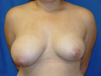 1_0000_194breast reduc (1).jpg