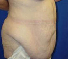 1_0028_tummytuckpt3 (2).jpg