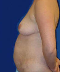 1_0046_tummy tuck pt5 (2).jpg