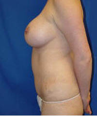 1_0047_tummy tuck pt5 (6).jpg