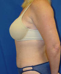1_0061_tummytuckpt4 (5).jpg