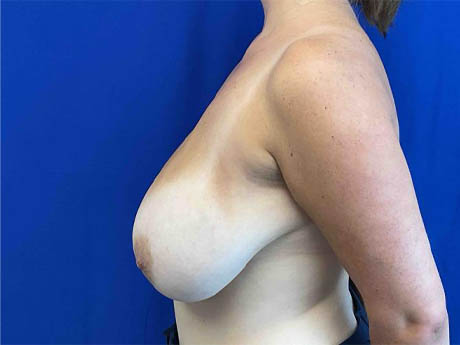 1_0006_Patient_Image 04_03_25 15_44_30_986.jpg Note- Uploaded via Nextech iPad app – Pa_Page_1_Image_0001.jpg